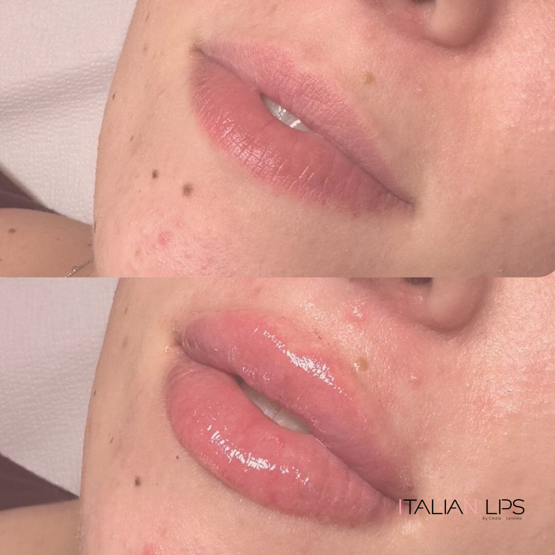 Esempio filler labbra (2)