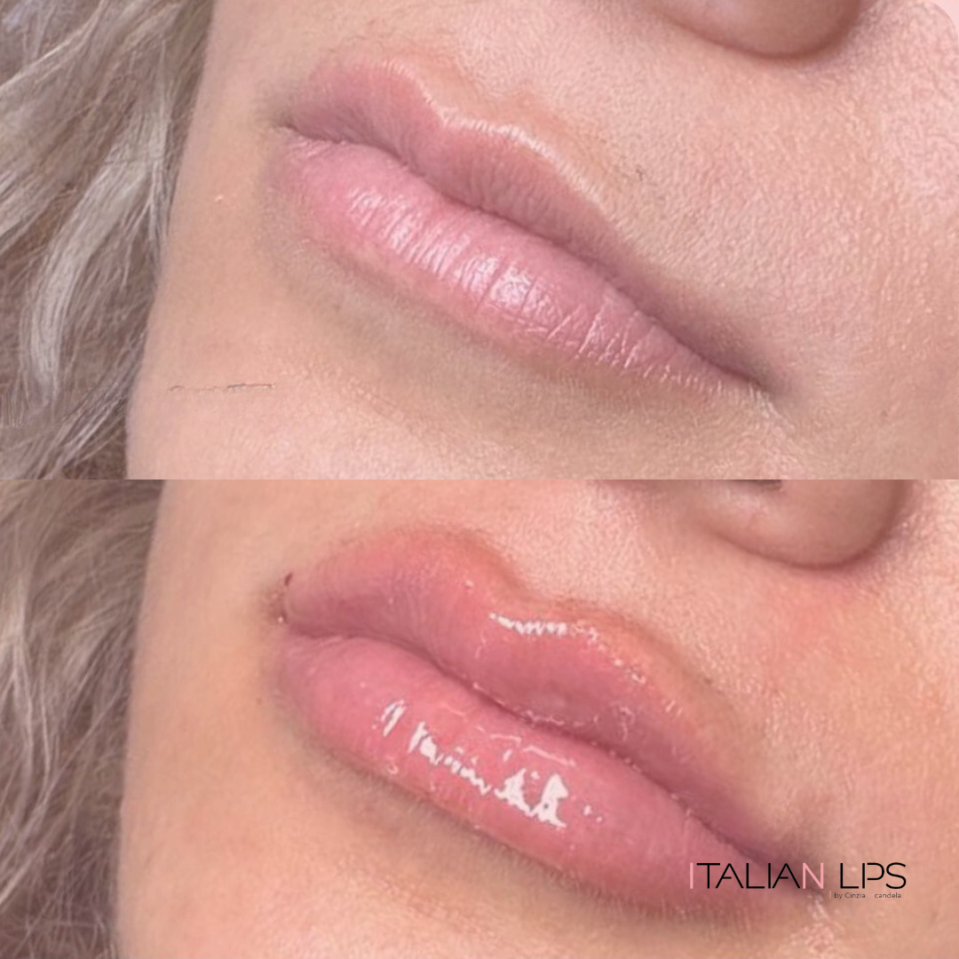 Esempio filler labbra (3)