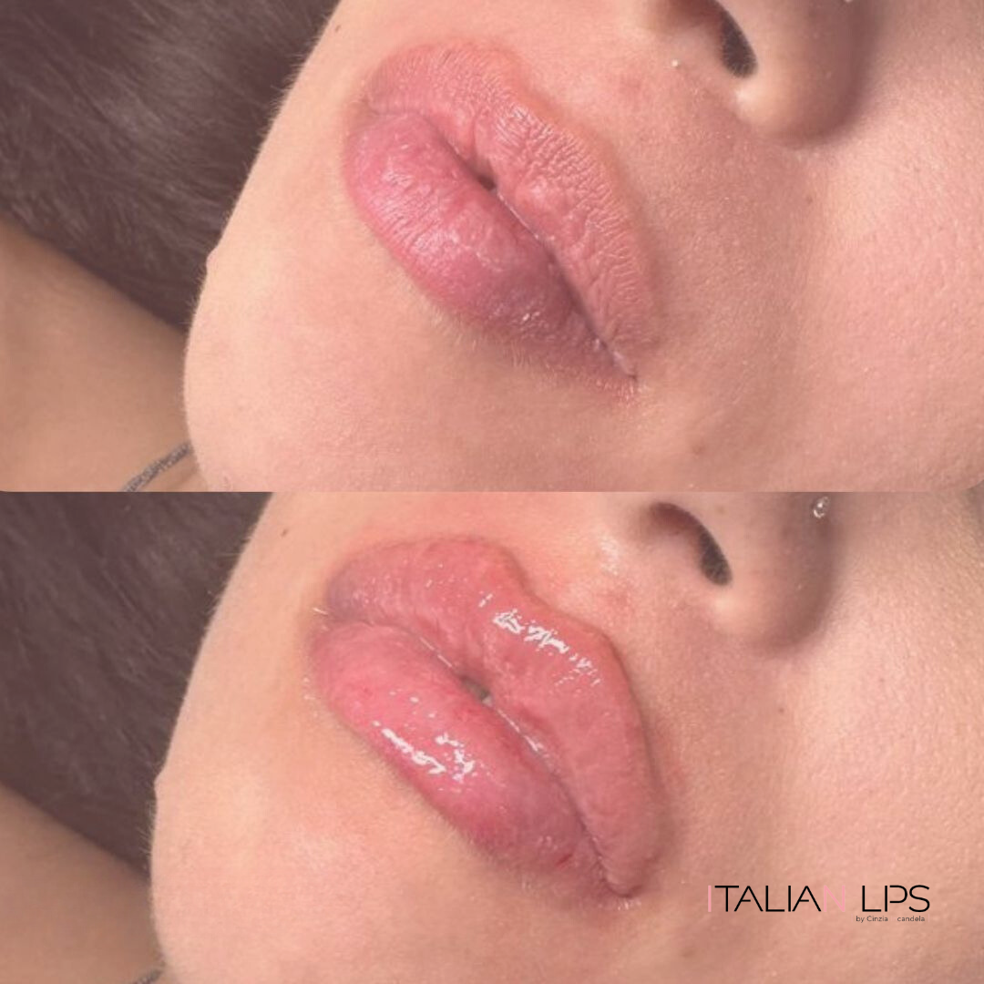 Esempio filler labbra (4)